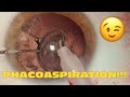 Phaco clip 235  phacospiration