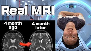 How did I Rejuvenate my Broken brain within 4 months ? (Reprogrm Your Brain) by ChipoChipo 398 views 1 month ago 8 minutes, 8 seconds