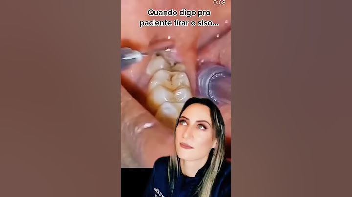 Isso pode causar uma dor terrível 😰 você já tirou o seu? #cirurgia #siso #dente #shorts