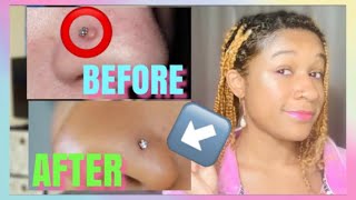 How to get rid of a bump/ keloid on nose piercing FAST!|REAL Divyne