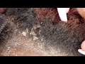 ITCHY DRY SCALP | SCRATCHING DANDRUFF | RAKING SCALP