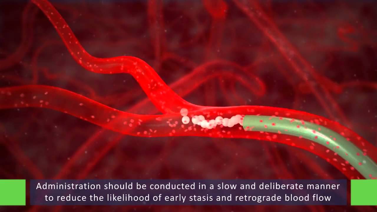 Лечение рака печени. SIRT терапия в Израиле. Радиоэмболизация печеночных артерий за рубежом