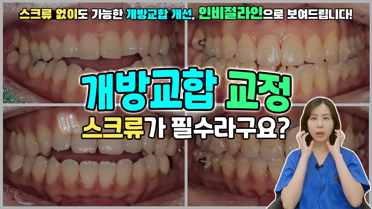 개방교합 교정, 인비절라인으로 스크류없이요?