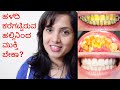 5m ದಲ್ಲಿ ಹಳದಿ ಹಲ್ಲಿನಿಂದ ಮುಕ್ತಿಗೆ ಮನೆ ಮದ್ದು | How To Whiten Yellow Teeth At Home Naturally In 5 Mins