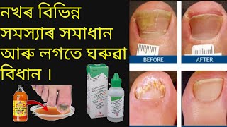 #gainknowledge #nailFungus how to get rid of nail fungus in assamese | নখচুকীয়া সমাধান | নখৰ যত্ন