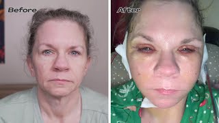 Facelift day 5 before and after: heres what I see