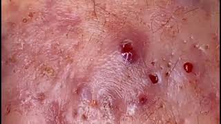 ??????? ????????? ??????? ?? ??? ???? ???? /new blackheads today 2023 youtube acne acnetreatment 8