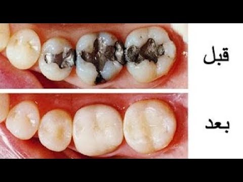 كيف تتخلص من تسوس الأسنان طبيعيا Youtube
