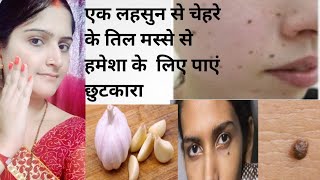 चेहरे से तिल और मस्से हटाने का घरेलु उपाय। Remove Face Moles From Your Face