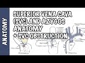 Superior vena cava and the azygos system clinical anatomy  - SVC obstruction (oncology emergency)