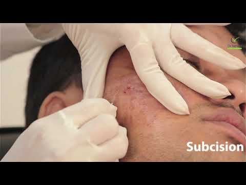 Subcision treatment for acne scars and wrinkles