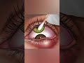 ASMR Eye Cleaning Treatment 👁️ Extreme Eye Infection Cleaning#asmr #animation #asmrcleaning