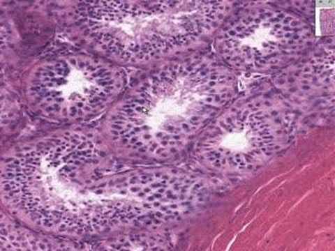 cancer prostata histologia
