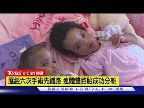 【CNN精選】衣索比亞連體雙胞胎 赴美分離手術傳捷報｜TVBS新聞