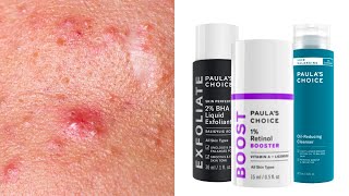 Top 7 Paulas Choice Skincare for Acne