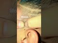liceinfestation813 #headliceremoval #licecomb #headlice #headlicetreatment #hairlice #haircare #hair