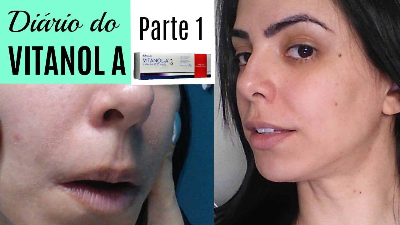 Tretinoina Antes E Depois Das Rugas