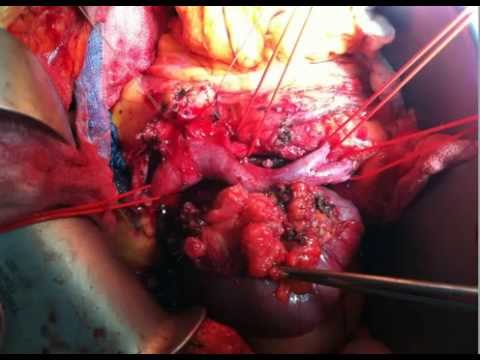 The Whipple Procedure with Portal Vein Resection