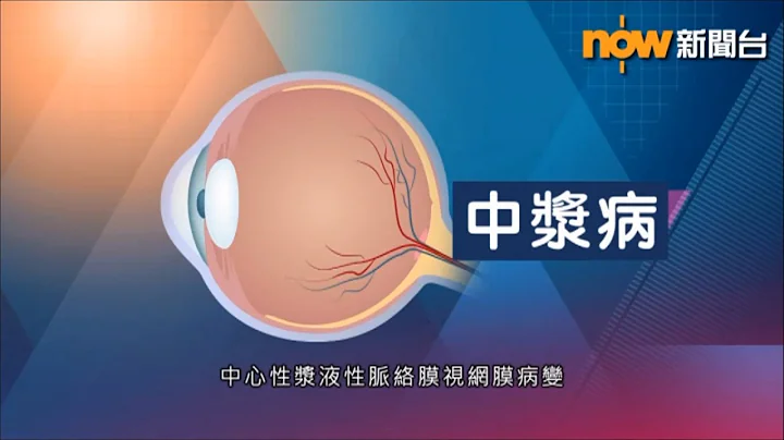 中大眼科 x Now 新聞：中漿病會令「黃斑點」滲水及水腫，隨時影響工作能力 - 天天要聞
