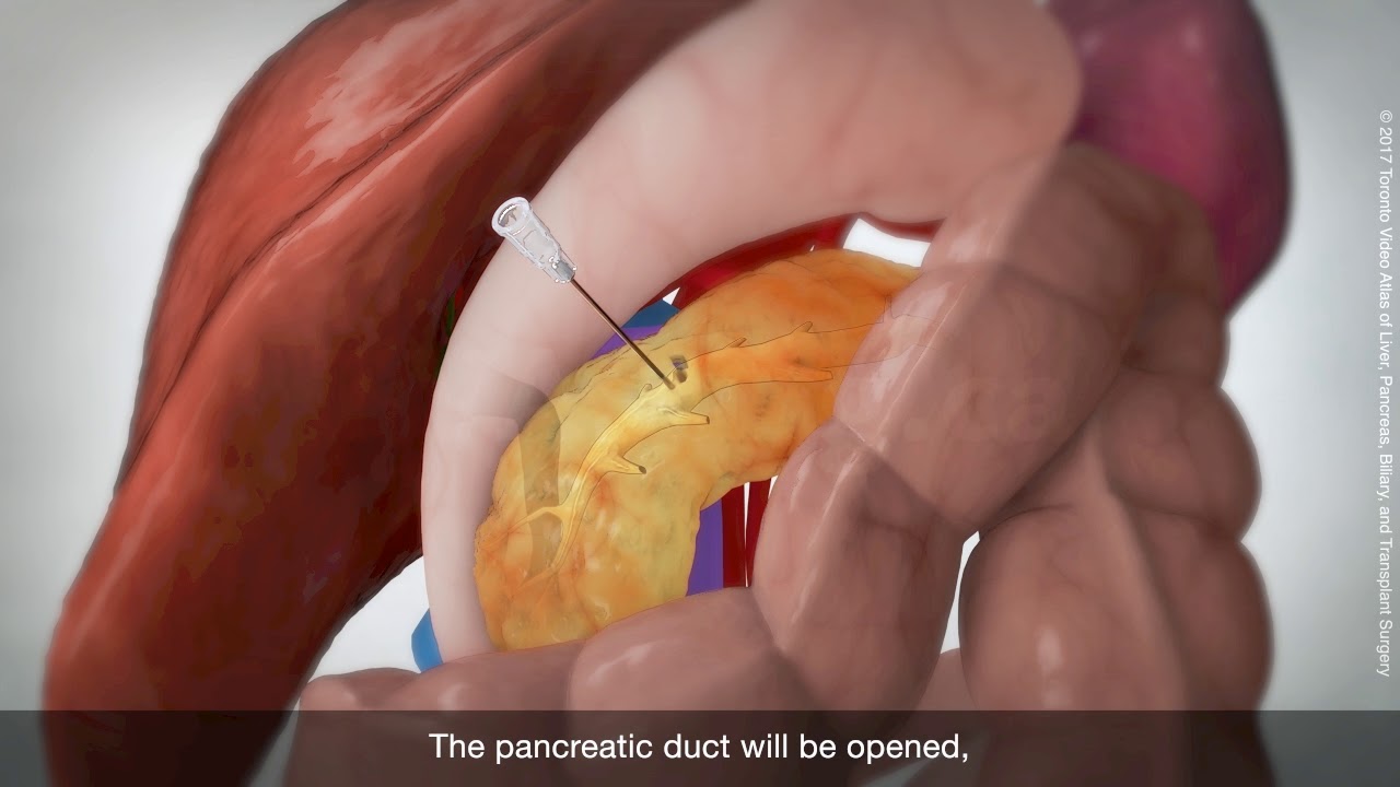 Longitudinal pancreaticojejunostomy (Puestow procedure) YouTube