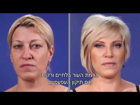 וִידֵאוֹ: זריקות הרמת עפעפיים ובוטוקס: פקריה יבגן שהשתנה חשוד בניתוחים פלסטיים