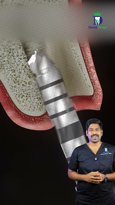 பல் பதியம் எப்படி செய்வார்கள்? -How a Dental Implant Procedure is Done? |Dr.Karthikeyan |Denta Kings