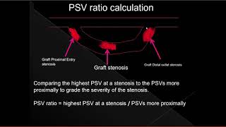 11 peripheral arterial triplex ultrasound  bypass graft surveillance triplex US Dr Ahmed esawy