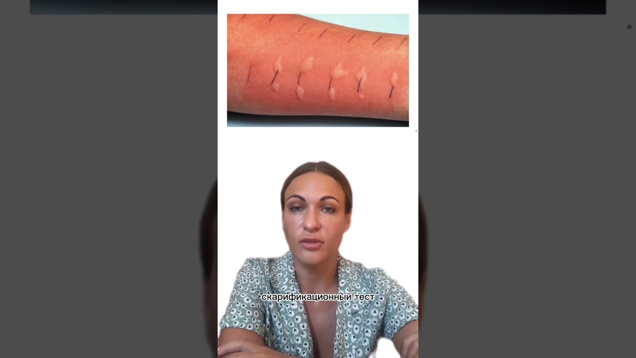 #педиатр #манту #проба_манту #пирке #туберкулинодиагностика #туберкулез