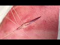 Deep dermal sutures