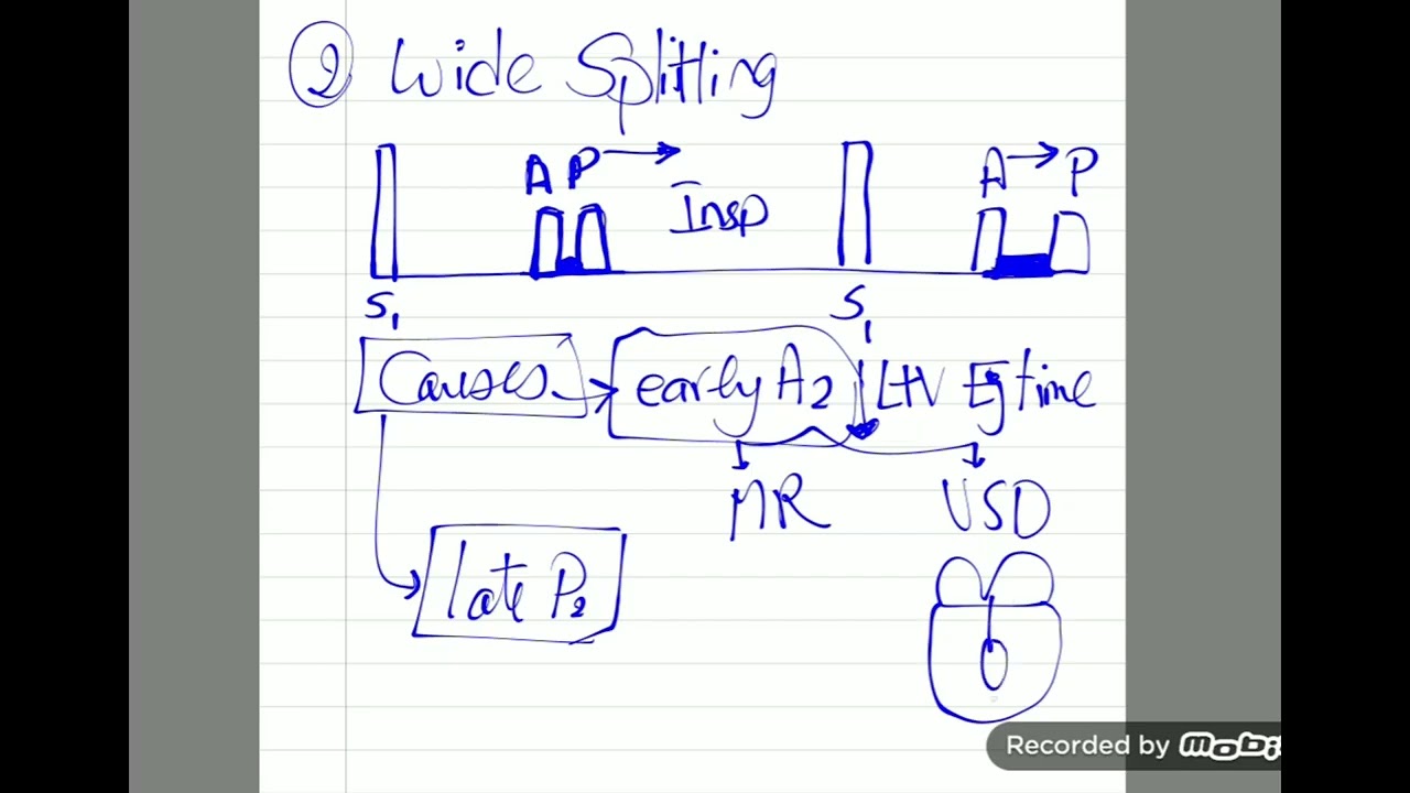cardiac examination 4 splitting of S2