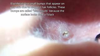 Biggest Blackhead!