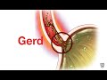 Mayo clinic minute  gerd is not just heartburn