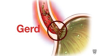 Mayo Clinic Minute - GERD is not 'just' heartburn Resimi