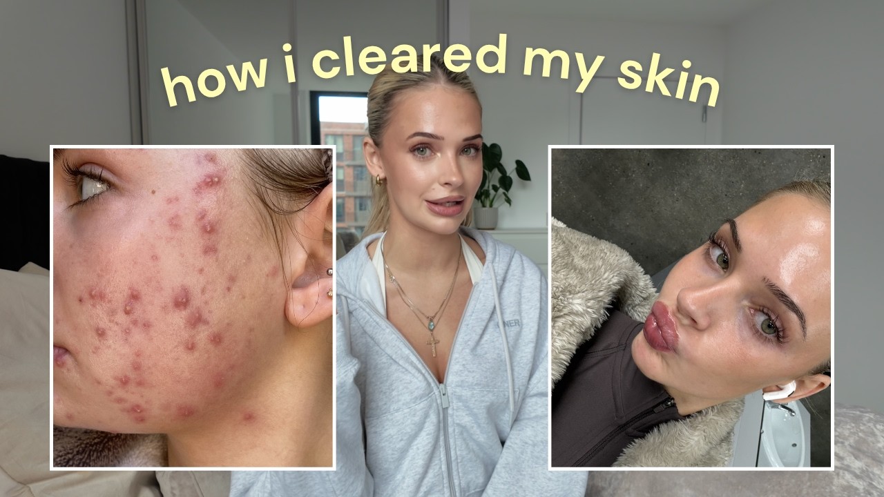 Accutane Treatment Journey and Skincare Routine for Acne Management