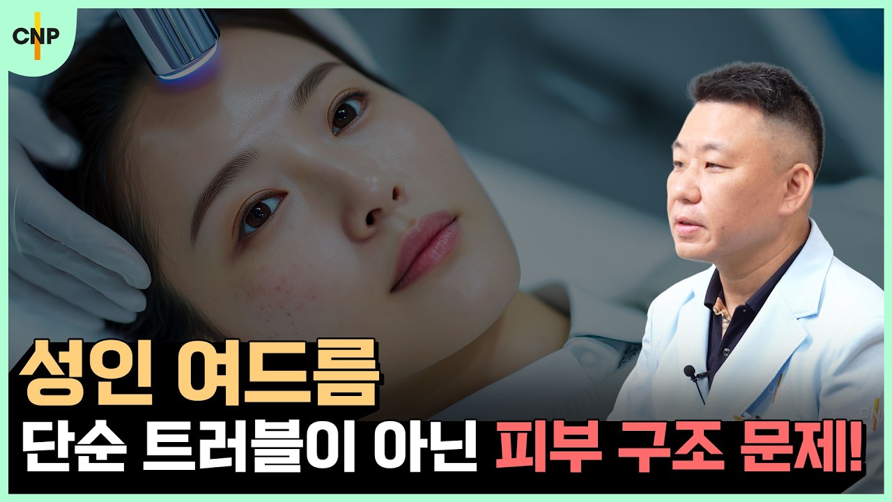 "여드름은 속부터 치료!" 성인 여드름은 단순 트러블이 아닌 피부 구조 문제!