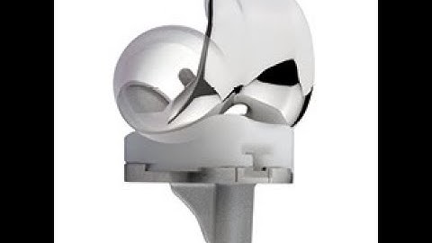 Evolution® Kinematic Alignment Patient Animation