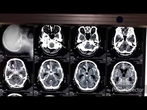 Video: Medfødt Aktivering Av Immunitet I Den Tidlige Hjerneskadeperioden Etter Subarachnoid Blødning