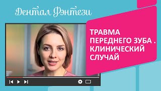 🦷 Травма переднего зуба. Клинический случай