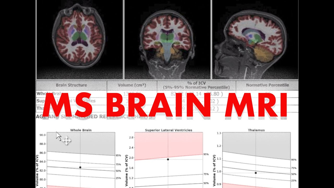 Image result for Understand your Brain Scan: MS MRI