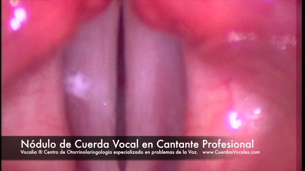 las cuerdas vocales inflamadas