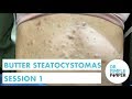 Butter Steatocystomas: Session 1