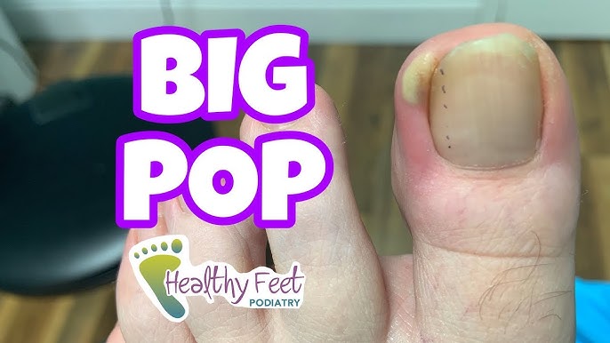 How to Ease the Pain of Ingrown Toenails, Pt. 2 - Palmetto State Podiatry
