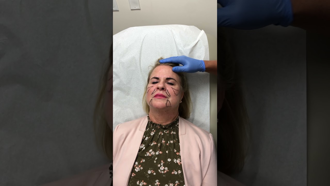 Full Face Transformation Using Botox and Fillers | Dr. Michael Kelly | Miami Plastic Surgery