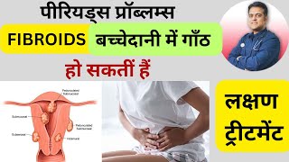 बच्चेदानी की गाँठों के लक्षण । Symptoms of uterine fibroids ।