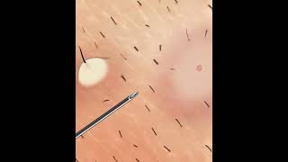 ASMR |  الرسوم المتحركة لإزالة الشعر تحت الجلد شعر ضخم تحت الجلد  ingrown hair removal animation
