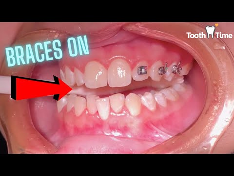 Video: Gjør tannregulering vondt å få dem på?