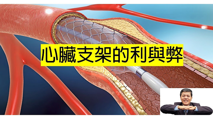 心脏支架利与弊：涂药支架比较好？ 如何改善味蕾？降低血管阻塞 - 天天要闻