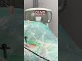 20 мм грижани Эндоскопик усулда олинди