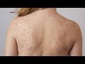 Hormonal Back Acne and Scarring Can be Embarrassing...See How to Clear Pimples, Acne and Blackheads