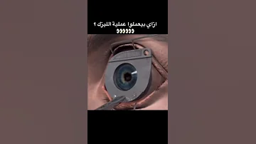 ازاي بيعملوا عملية الليزك 